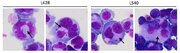 CD30は古典的ホジキンリンパ腫においてリード・シュテルンベルグ細胞と複雑な染色体異常の形成に関与する--北里大学